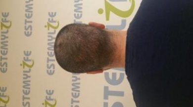 hair transplant in Turkey (4)