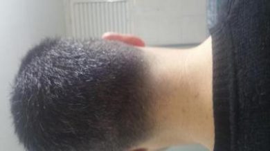 hair transplant in Turkey (5)