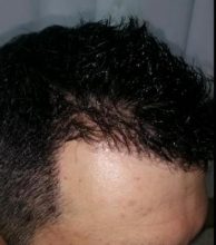 hair transplant in Turkey (6)