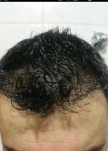 hair transplant in Turkey (7)