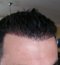 hair transplant in Turkey (8)
