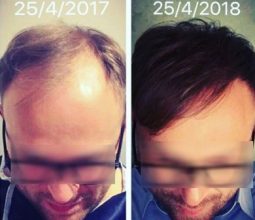 hair transplant in Turkey cost