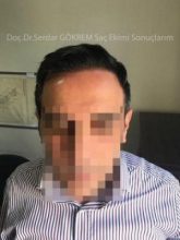 hair transplant in turkey by doctor (1)