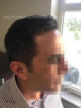 hair transplant in turkey by doctor (10)