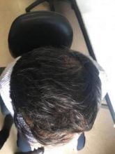 hair transplant in turkey by doctor (2)