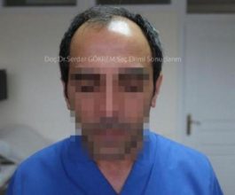 hair transplant in turkey by doctor (3)