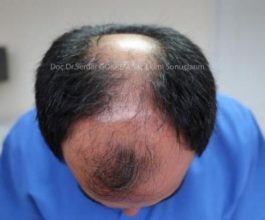 hair-transplant-in-turkey-by-doctor