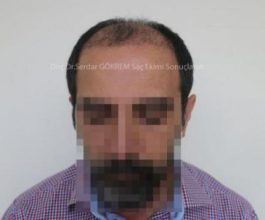 hair transplant in turkey by doctor (5)