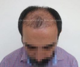 hair transplant in turkey by doctor (6)