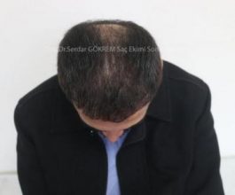 hair transplant in turkey by doctor (8)