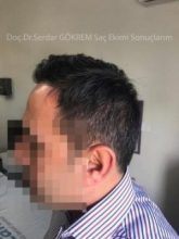 hair transplant in turkey by doctor (9)