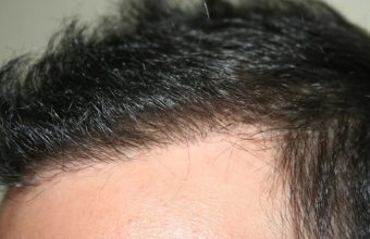 hair transplant in turkey forum (1)
