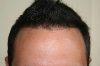 hair transplant in turkey forum (10)