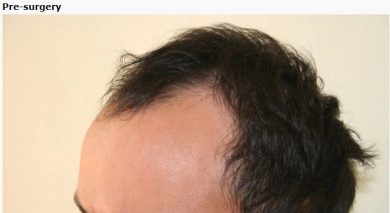 hair transplant in turkey forum (11)