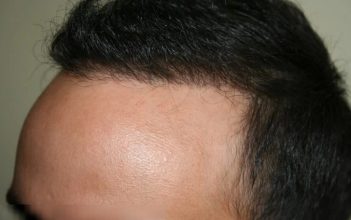 hair transplant in turkey forum (12)