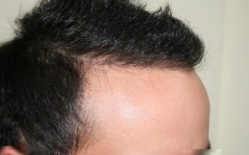 hair transplant in turkey forum (13)