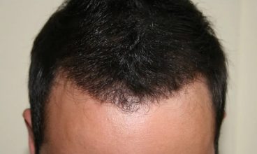 hair transplant in turkey forum (14)