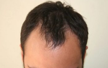 hair-transplant-turkey-forum