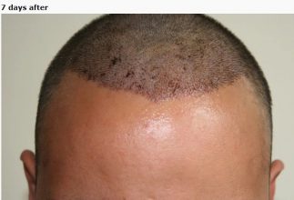 hair transplant in turkey forum (3)