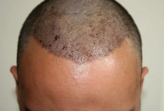hair transplant in turkey forum (5)
