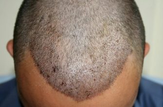 hair transplant in turkey forum (6)