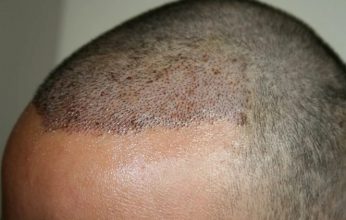 hair transplant in turkey forum (7)