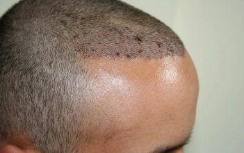 hair transplant in turkey forum (8)