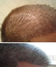hair transplant in turkey package (7)