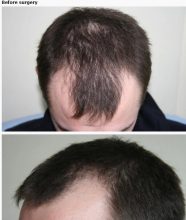hair transplant in turkey package (8)