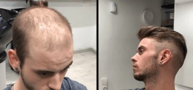 hair transplant money
