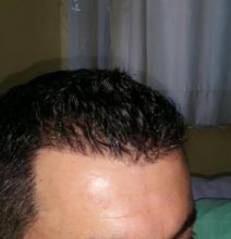 hair transplant reviews (1)