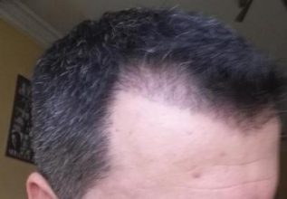 hair transplant reviews (10)