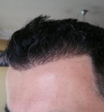 hair transplant reviews (11)