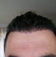 hair transplant reviews (12)