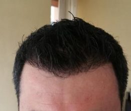 hair transplant reviews (2)