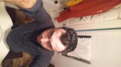 hair transplant reviews (3)