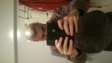 hair transplant reviews (4)