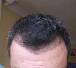 hair transplant reviews (7)