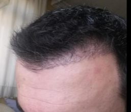 hair transplant reviews (8)