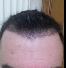 hair transplant reviews (9)
