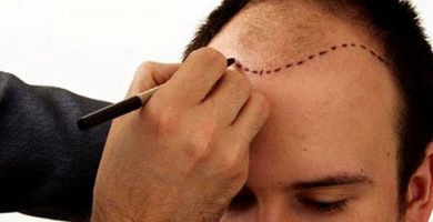 hair-transplant-turkey