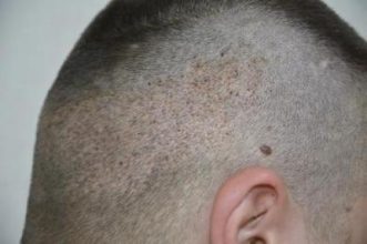 hair transplant turkey antalya (10)