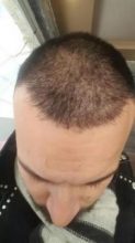 hair transplant turkey antalya (11)