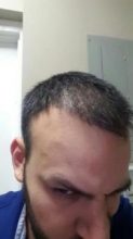 hair transplant turkey antalya (12)