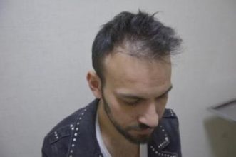 hair transplant turkey antalya (3)