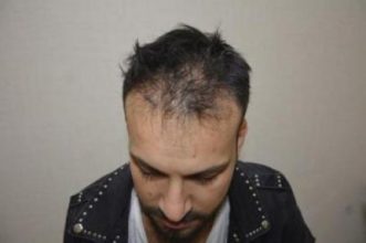 hair transplant turkey antalya (4)