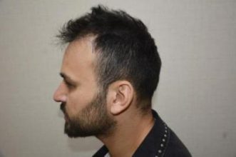 hair transplant turkey antalya (5)