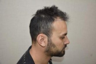 hair transplant turkey antalya (6)