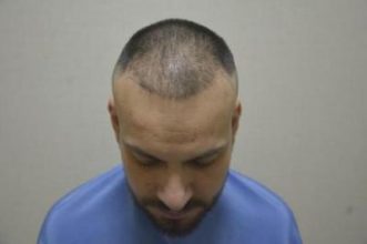 hair transplant turkey antalya (7)