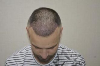 hair transplant turkey antalya (9)